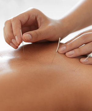 Dry Needling